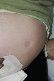Figure 1 Pitting oedema of the abdominal wall